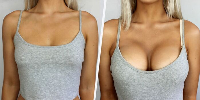 przed i po operacji plastycznej powiększania piersi