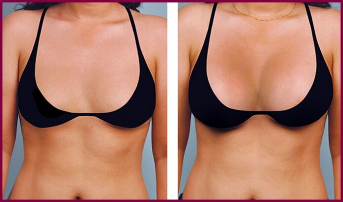 przed i po powiększeniu piersi tłuszczem