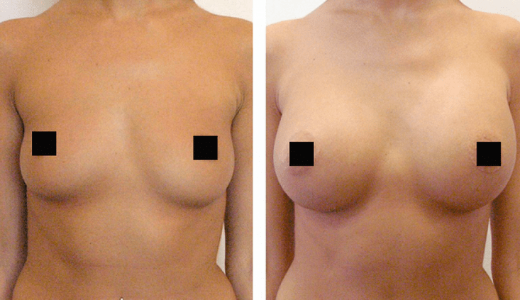 piersi przed i po powiększeniu kwasem hialuronowym