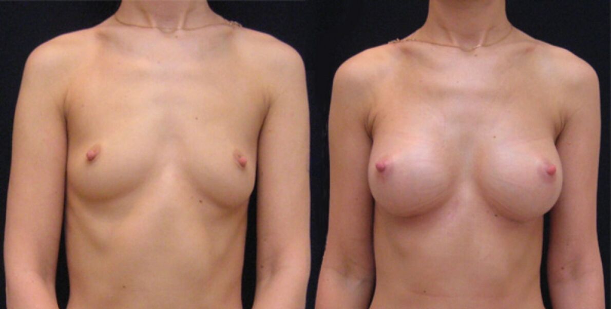 piersi przed i po endoskopowej augmentacji