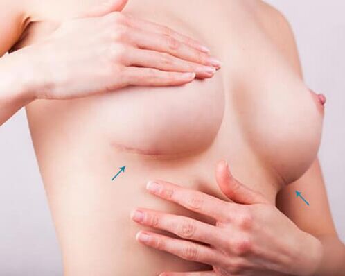 Powiększenie piersi za pomocą implantów