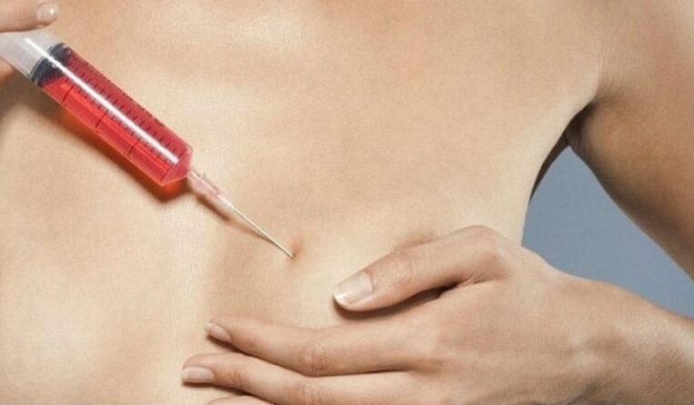 Powiększanie piersi zastrzykami z kwasu hialuronowego